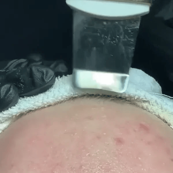 50% OFF TEMPORÄR  SkinSonic™